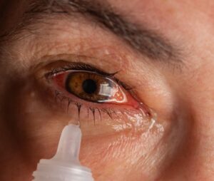 woman with painful, hot, itchy dry eye